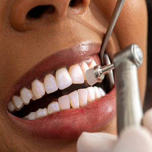 Limpieza Dental